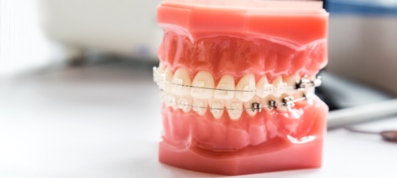 歯ならびを治すためには歯列矯正